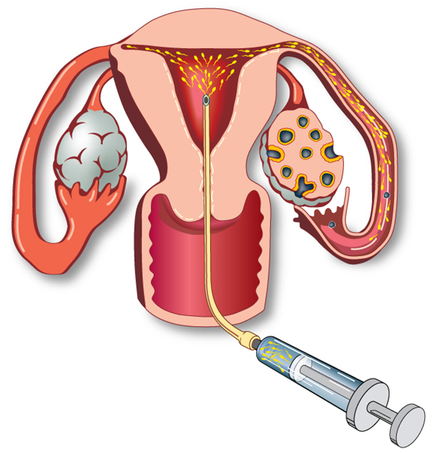 a 人工授精(微信号ivf2022)人工授精地址官网资讯价格费用代孕试管助孕代怀yed em Promoção na Shopee Brasil  2023